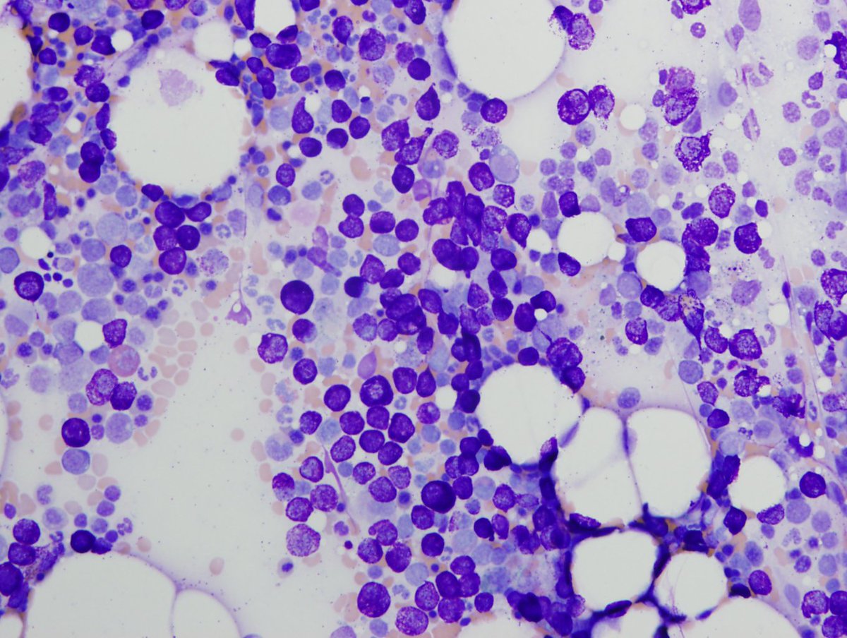 Correct! As good  #pathologists we will of course request more tissue to examine, and the patient needs a bone marrow biopsy to evaluate extent of disease (i.e. cutaneous vs systemic). Images from this patient's aspirate and biopsy are shown below (1/4):