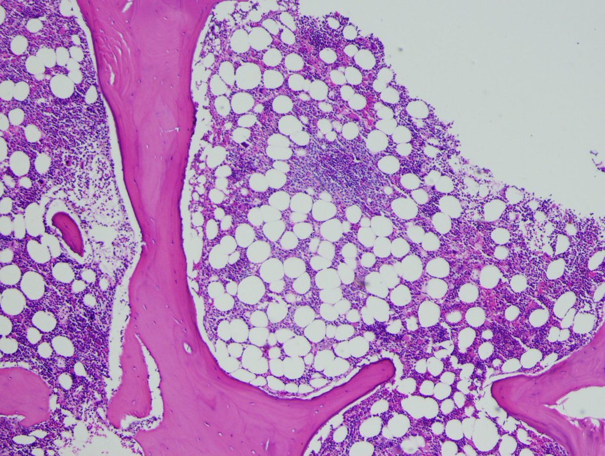Correct! As good  #pathologists we will of course request more tissue to examine, and the patient needs a bone marrow biopsy to evaluate extent of disease (i.e. cutaneous vs systemic). Images from this patient's aspirate and biopsy are shown below (1/4):