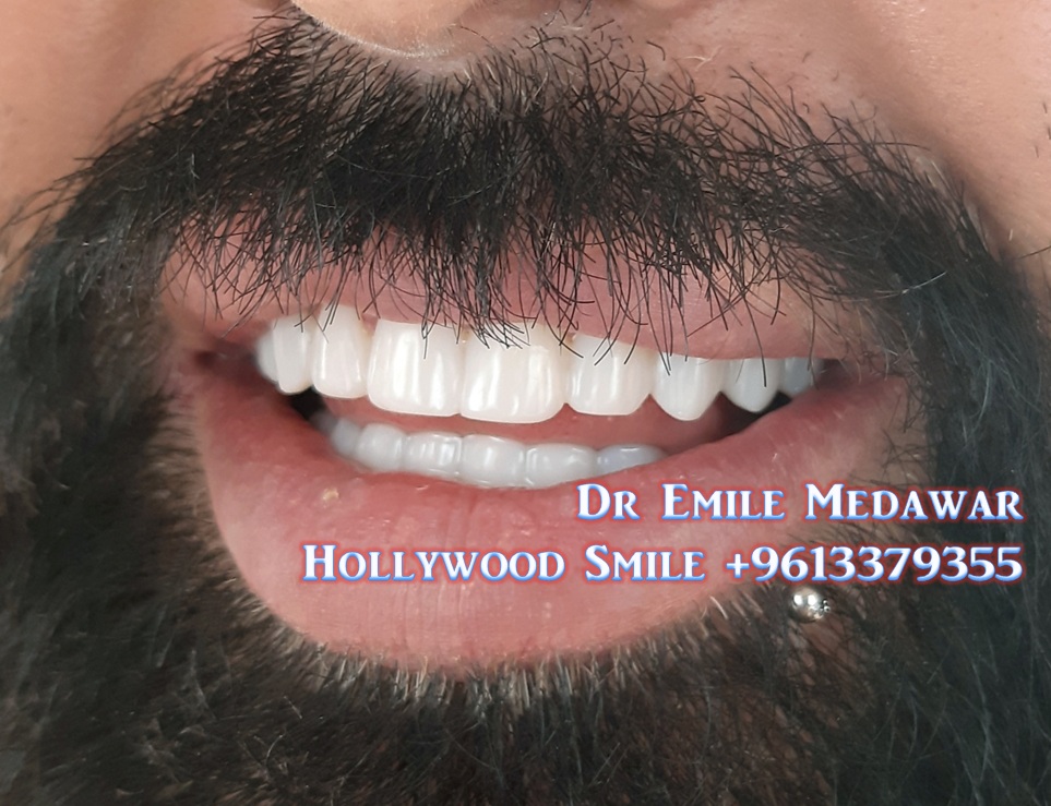 veneerlebanon's tweet photo. Dr Emile Medawar #CosmeticDentist #DentalImplants #Surgeon #OralSurgery #Specialist #Lebanon #Beirut #SinElFil 00 961 3 379355
#HollywoodSmile #PorcelainVeneers #DirectCompositeVeneers #VeneersCost #SmileCelebrity #PerfectTeeth
emile_medawar@hotmail.com
https://t.co/g05w0YKWg7 https://t.co/1CzeIvzT5c