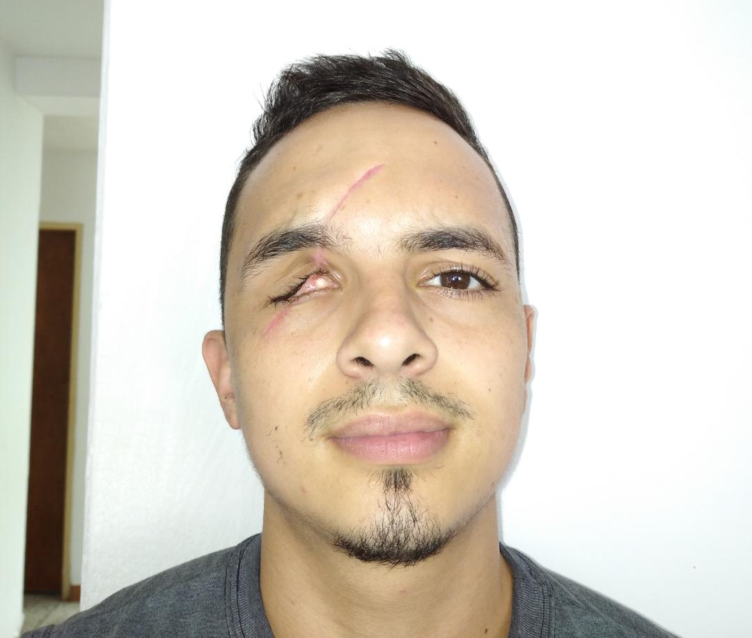 MamaLisVzla's tweet photo. Se acuerdan de Aaron, el chamo que fue asaltado cuando regresaba de Colombia a Táchira, y  brutalmente atacado, ocasionando la pérdida de un ojo? Ya tengo su informe y su presupuesto para la primera cirugía. Son 240$.Por favor vamos a ayudarlo, donen en el gofundme o Zelle. https://t.co/fZhB8IzxkZ