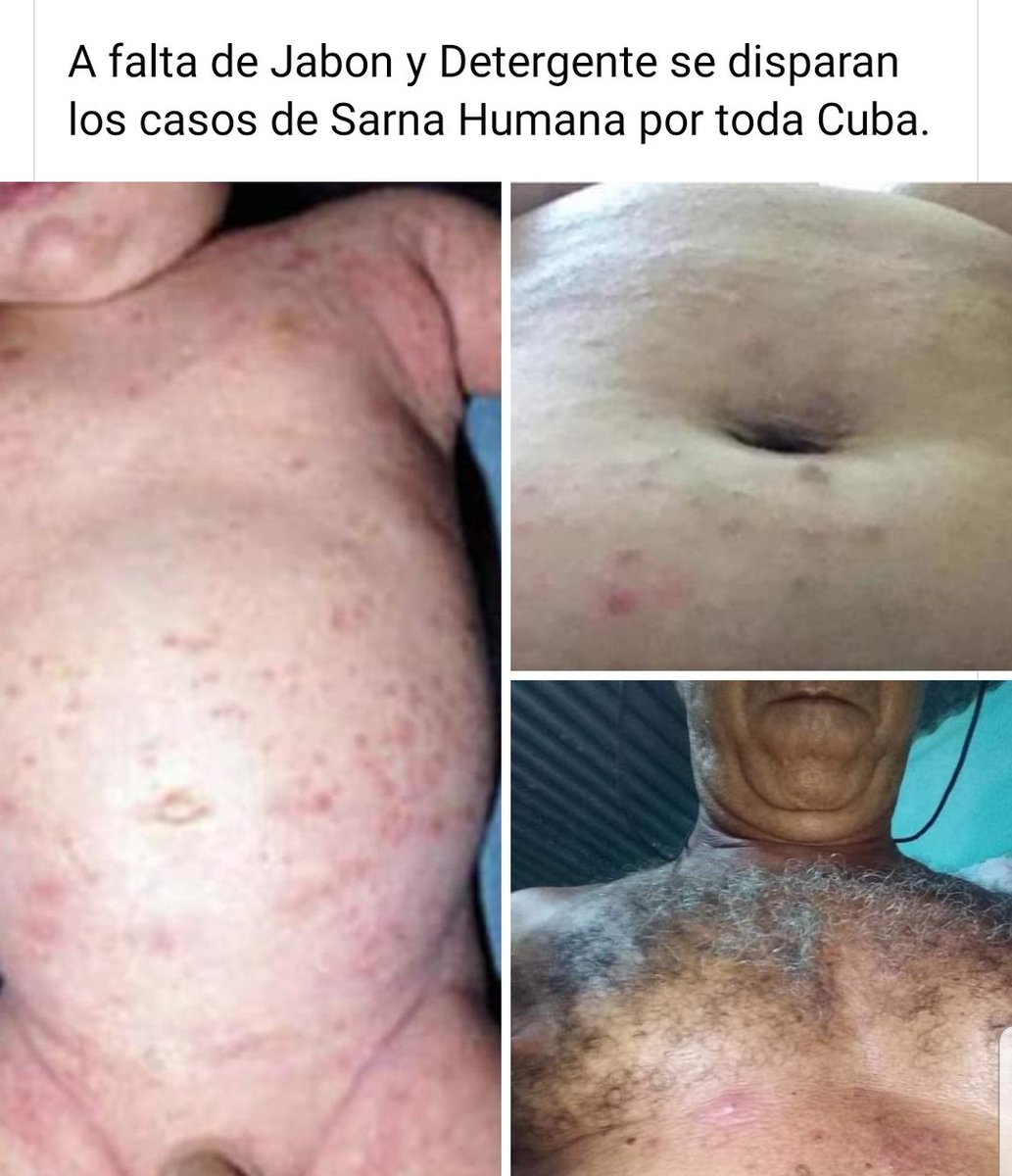 CubanaRealidad's tweet photo. @DiazCanelB Asmáticos sin medicamentos y niños con sarna humana que no tienen medicamentos para curarse. Es una vergüenza, 60 años después y estamos peor que en 1959.
#Cuba #Dictadura @PresidenciaCuba @MINSAPCuba @DiazCanelB https://t.co/auprzrV2w5