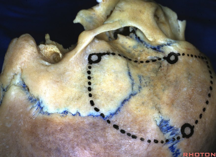 NASBSorg's tweet photo. #NASBS #anatomy The #pterion is located at the lateral near the junction of the squamosal, coronal, sphenoparietal, & frontosphenoid sutures. The lower end of the pars triangularis is located behind the pterion. https://t.co/EJl3O3eEVX https://t.co/Fdmb9P1PMp
