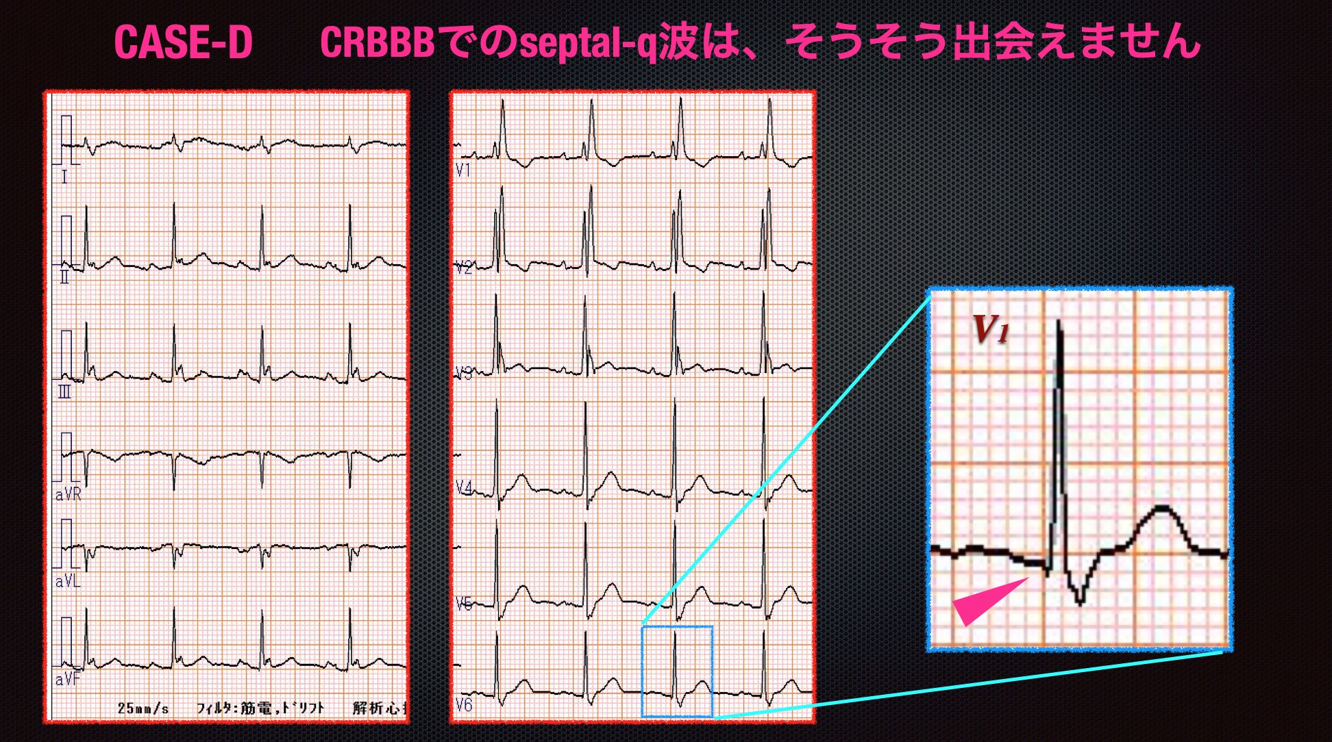 N Tsukishima Ep大学心電図検定学部試験対策科担任 On Twitter Crbbb 08 Septal Q Waveの消失とは V5 6 Amp I誘導でq波を認めない場合に云われます 新たな Septal Q Waveの消失 は 中隔部の虚血 変性 Sarcoidosis Amyloidosisなど を想起しますが もともと