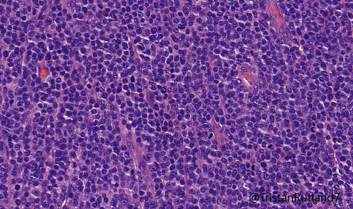Tristan Rutland MBBS FRCPA IFCAP (@tristanrutland7) on Twitter photo Large bowel, older patient.
@ZHOUSEH @MattieFarzin <a href="/ariella8/">Celina Stayerman MD</a> <a href="/RunjanChetty/">Runjan Chetty</a> <a href="/ALBoothMD/">Adam L. Booth, MD</a> <a href="/Dr_Brian_Cox/">Brian Cox, MD, MAS</a> <a href="/DrBMcGinn/">Barry McGinn</a>
#GIPath #Surgpath #PathTwitter #pathology Large bowel, older patient.
@ZHOUSEH @MattieFarzin <a href="/ariella8/">Celina Stayerman MD</a> <a href="/RunjanChetty/">Runjan Chetty</a> <a href="/ALBoothMD/">Adam L. Booth, MD</a> <a href="/Dr_Brian_Cox/">Brian Cox, MD, MAS</a> <a href="/DrBMcGinn/">Barry McGinn</a>
#GIPath #Surgpath #PathTwitter #pathology