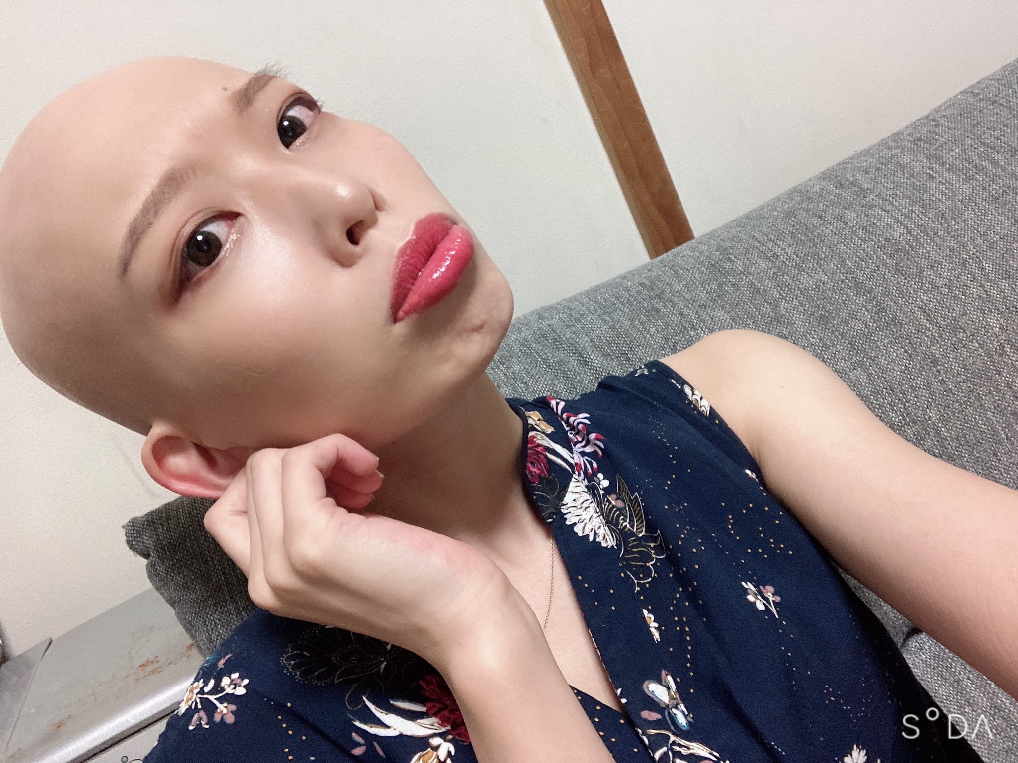 優 早く治るといいね とか 治らないの って聞かれるけど 脱毛症は治療法が確立していない病気です 私は髪がない自分も好きなのであえて 治さない選択 をしているため現在治療はしていません Mixchannel Modecon スキンヘッドモデル