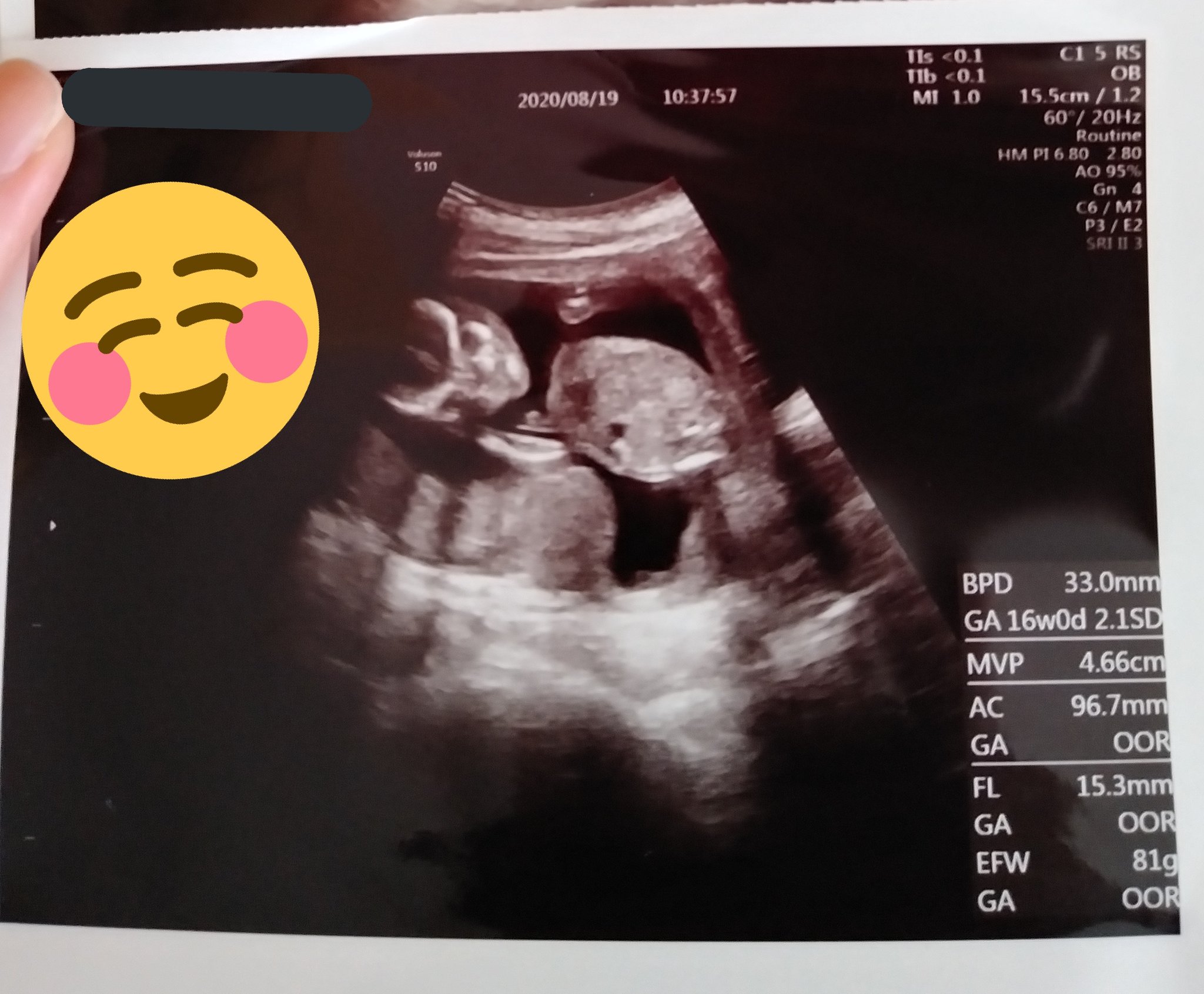 Touka 今日は午前中に14週目の妊婦健診に行ってきたよᕙ ᕗ 順調に育っています 今日のエコー 画像は赤ちゃん顔とか手とか色々がよく写っていて嬉しいです 艸 そういえば 性別はどっちになるかな V 楽しみです 赤ちゃんと