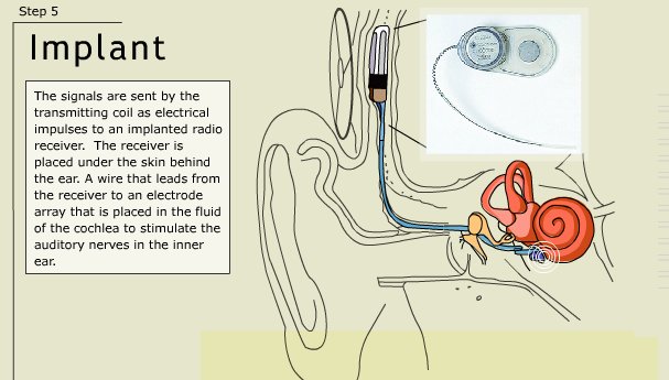 ...passes the signal to the implant, which is surgically implanted into the fluid of the cochlea. The implant excites the nerve fibers with the signal, and they take it to the brain. And lo! The person can hear the sound !