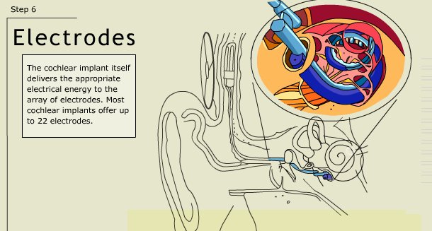 ...passes the signal to the implant, which is surgically implanted into the fluid of the cochlea. The implant excites the nerve fibers with the signal, and they take it to the brain. And lo! The person can hear the sound !