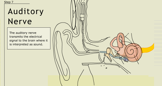 ...passes the signal to the implant, which is surgically implanted into the fluid of the cochlea. The implant excites the nerve fibers with the signal, and they take it to the brain. And lo! The person can hear the sound !