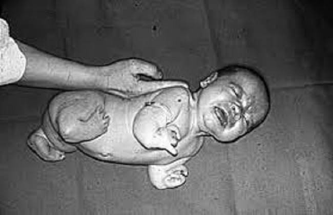 The following year, thousands of babies were born with severe birth defects (brain damage, deformed limbs). In 1961, doctors proved a link between the birth defects & the drug & it was pulled off the shelves. However, almost 40% of the babies affected lost their lives.
