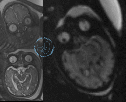 Fetal_Imaging's tweet photo. 35-36 week fetus. Do you "see" the problem? #MedEd #PedsRad #fetalMRI #Radiology #FOAMed #prenataldiagnosis https://t.co/EHJAHLfJvL