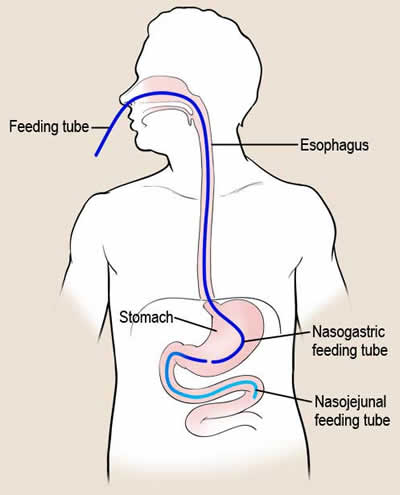 This is a nasogastric tube. It would be inserted through your nose passing through the back of your mouth into your esophagus. We use it to feed you or give you oral medications in case you need them.