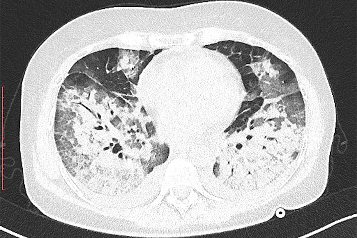 This would be a CT scan of your lungs, as compared to normal ones.