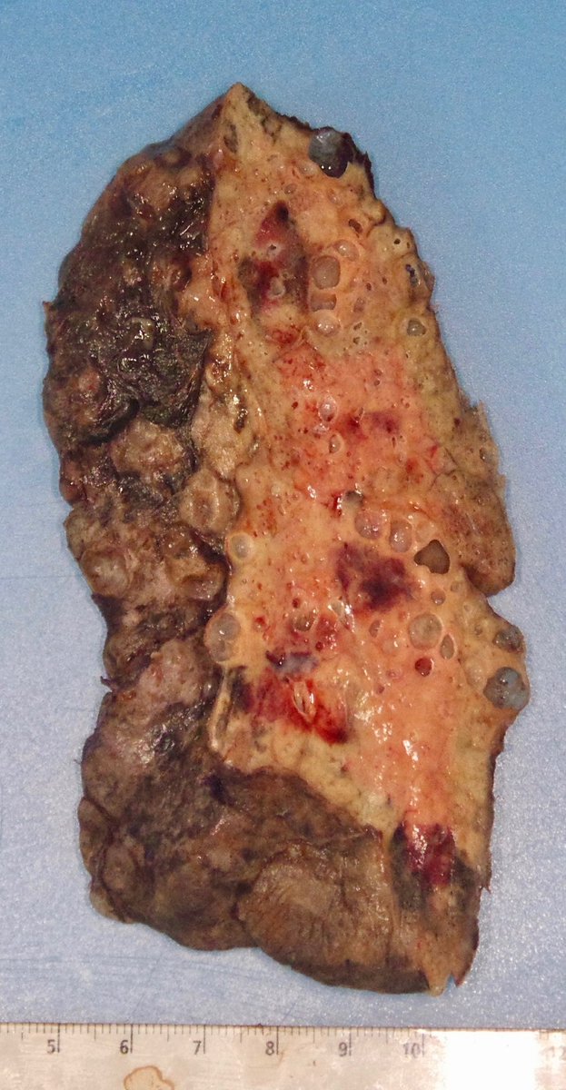 This would be your lung compared to a normal one.