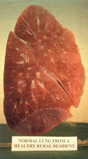 This would be your lung compared to a normal one.