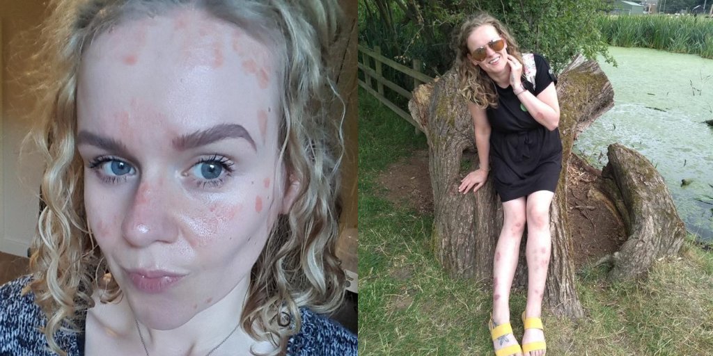 PsoriasisUK's tweet photo. 'I decided to take part in the #PsoProtectMe survey... the research can help find out if we are at added risk by being on certain medications'

Jessica shares her experiences with #psoriasis during the #pandemic &amp; why she added her voice to PsoProtectMe: https://t.co/8gf7C0wifs https://t.co/sOkMVYLhrF