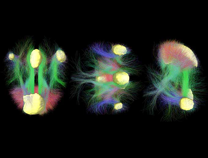 MGHNeuroSci's tweet photo. Many who survive severe COVID-19 experience a prolonged disorder of consciousness. David Fischer, MD, Brian Edlow, MD, of @MGHNeurology, and colleagues show that the default mode network (DMN) in a ventilated (<40 days) COVID-19 patient was intact https://t.co/r1wyxdEhhP https://t.co/PFIsDlMStN