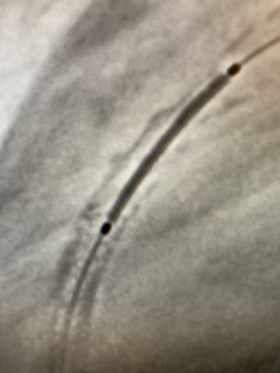 lamelaspablo's tweet photo. How do you make 1 stent using 2 stents? Easy with #stentboost @Philips #radialfirst https://t.co/1cSaW7CSu4