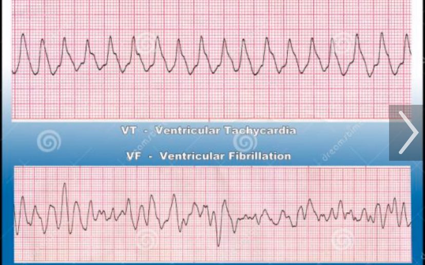 I learnt to remember VF and VT as Very Fluffy and Very Tidy! This type of association agrees with my brain! How about yours? Haha