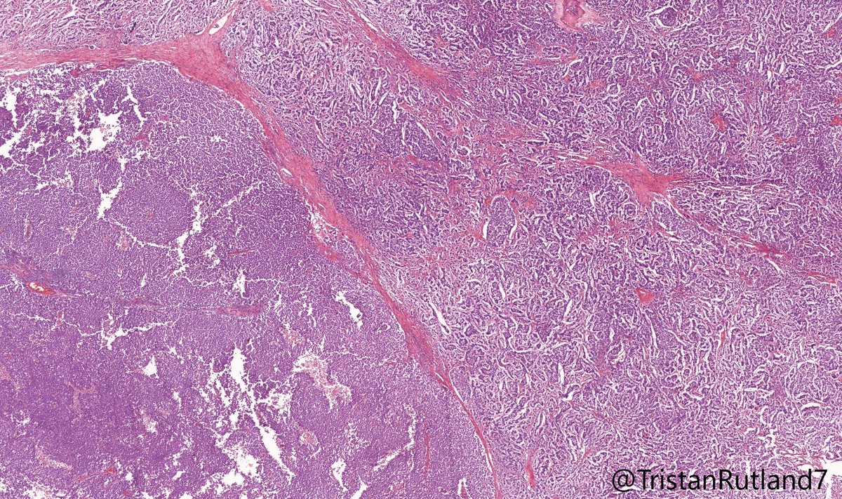 Testis @ZHOUSEH  @MattieFarzin  @DrGeeONE  @Teclis82  @WebPathology  @Kashifhazim  @MAHoureih  @Meghna0630  @Divya_Madhala  #GUPath  #PathTwitter  #surgpath