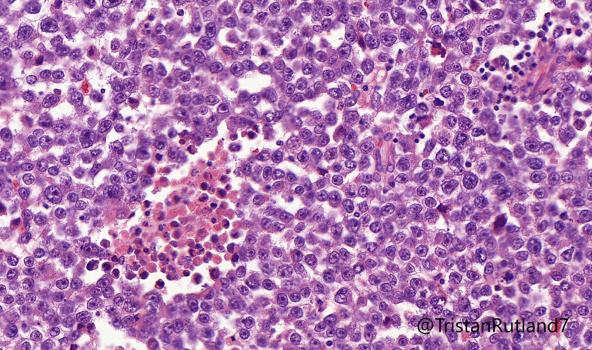 High power view of nodule on the right hand side.