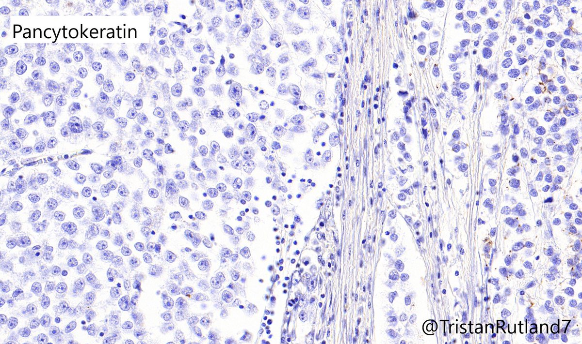 Pancytokeratin