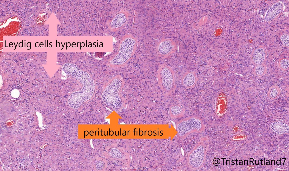 4/ Lastly, this case also had classic changes of cryptorchidism (see images below).