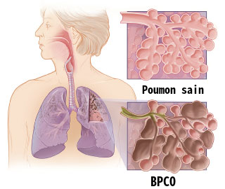 🫁💊 Bêta-bloquant et bronchopneumopathie chronique obstructive : un essai prospectif
Dr Paul Desforges
 ➡️ mediamed.org/pneumologie/bp…