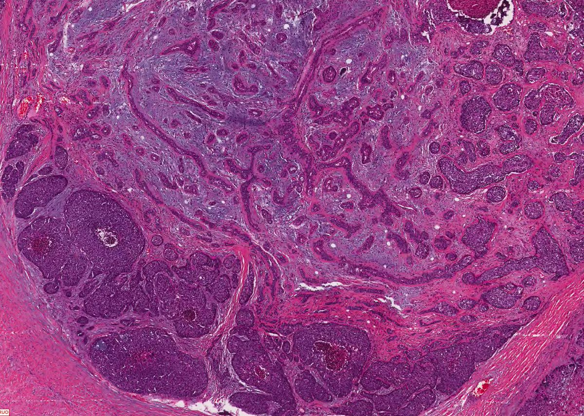 Question 4: Parotid mass, recent growth.