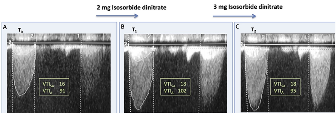 Elegant study highlighting the dependence of transaortic gradients on blood pressure in patients with aortic stenosis

onlinejase.com/article/S0894-…