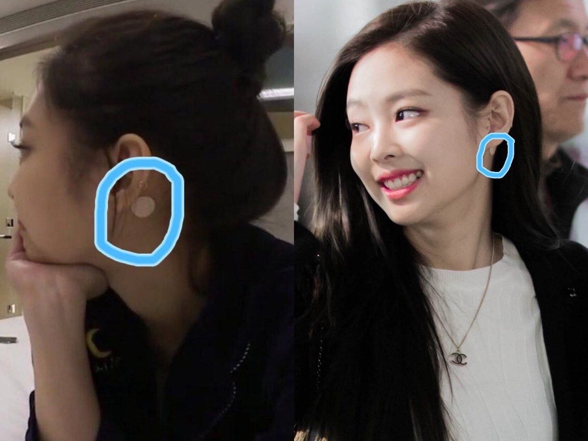 There are more times she has hurt this same ankle through the next years.Jennie also has motion sickness, panic attacks, allergies, weak stamina, low pain tolerance and other health problems which much or less affect her performance and daily live in a way
