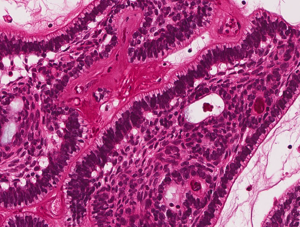  #ENTPath - Quick 'stainless'  #PathBoardReviewFirst up: Maxillary mass