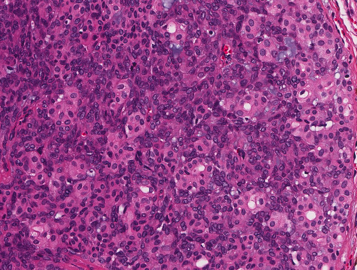 Spiradenoma. Basophilic nodules in the dermis with biphasic appearance. Focal duct formation. Remember the overlap with cylindroma.