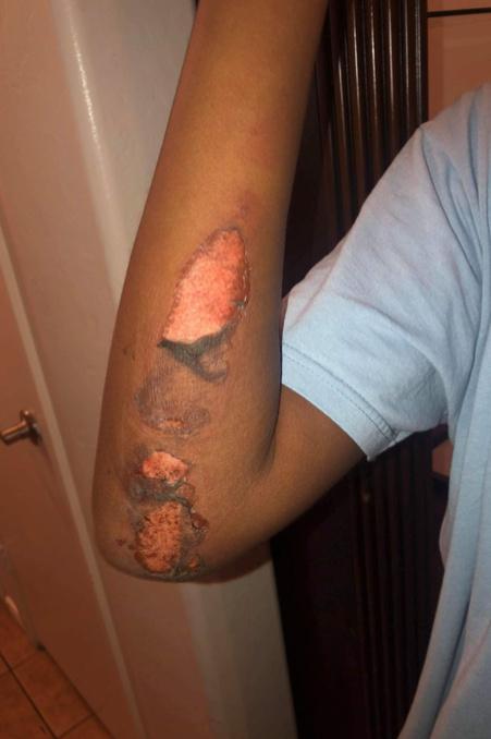 “My face was burning. I have never felt nothing so hot,” Roniah said, recalling how she screamed for help and felt like she was going to pass out. “When they did eventually get me off the floor, the pavement had burned my skin off." (image of her arm after incident + scars today)