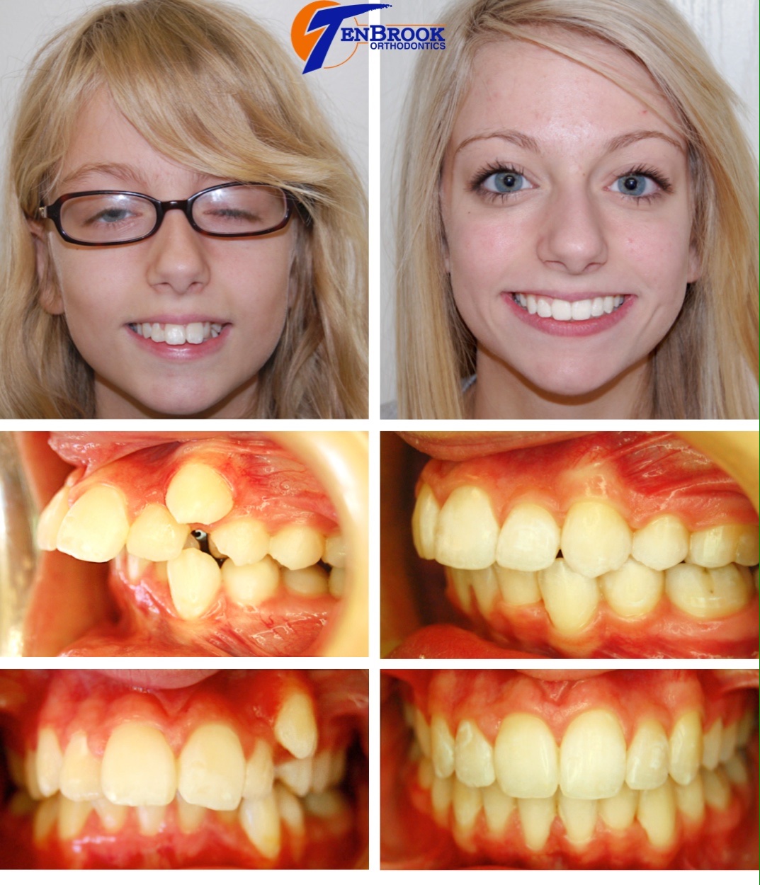 TenBrook Orthodontics on Twitter "𝐓𝐡𝐞𝐬𝐞 𝐛𝐞𝐟𝐨𝐫𝐞 𝐚𝐧𝐝 𝐚𝐟𝐭𝐞𝐫 𝐩𝐡𝐨𝐭𝐨𝐬 𝐬𝐚𝐲 𝐢𝐭
