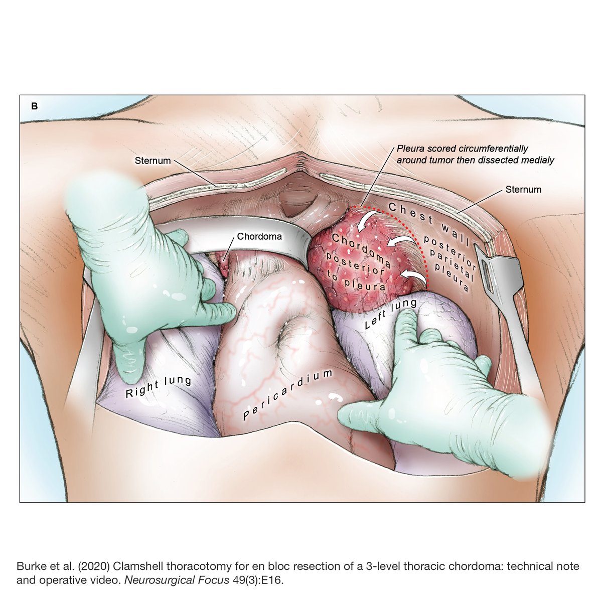 UCSF Neurosurgery (@neurosurgucsf) on Twitter photo Published today on the cover of #NeurosurgicalFocus, UCSF neurosurgeon Praveen Mummaneni, resident <a href="/JohnFredBurkeMD/">John F Burke</a> & team describe a rare case of thoracic chordoma which required an unusual approach. Read about the bilateral clamshell thoracotomy here: neurosurgery.ucsf.edu/news/spinal-ch… Published today on the cover of #NeurosurgicalFocus, UCSF neurosurgeon Praveen Mummaneni, resident <a href="/JohnFredBurkeMD/">John F Burke</a> & team describe a rare case of thoracic chordoma which required an unusual approach. Read about the bilateral clamshell thoracotomy here: neurosurgery.ucsf.edu/news/spinal-ch…