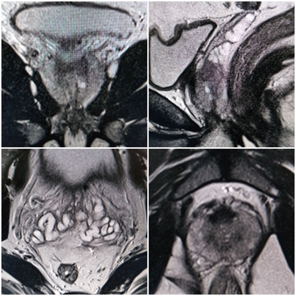 lameliav's tweet image. Resonancia Multiparamétrica de próstata. Paciente de 49a, con cambios sugestivos de Prostatitis. DWI sin restriccióny perfusión captación difusa,  Pirads 3.
#RMmp #próstata #difusión #perfusión #draluisavera