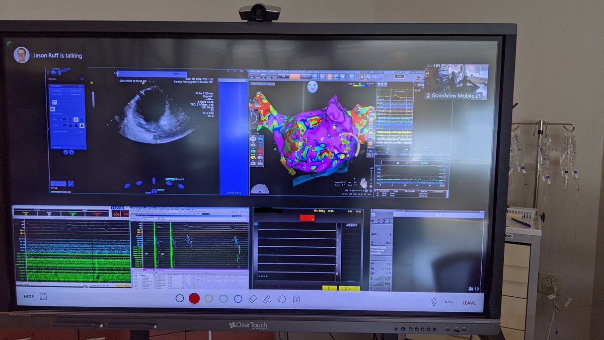 Live transmission of AF ablations to my fellow brazilian EP docs today. #EPeeps