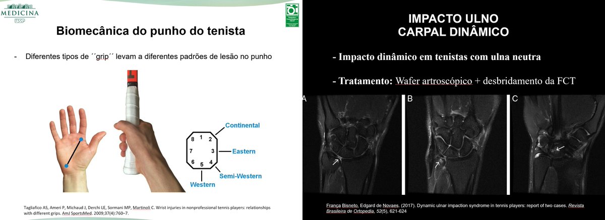 Today I had the pleasure of presenting an interesting case about ulnar wrist pain in tennis players in the #FMUSP Orthopedics Department online meeting! Great discussion about forehand tennis grips in modern tennis and their relation to wrist injuries! #SportsMedicine #Physiatry