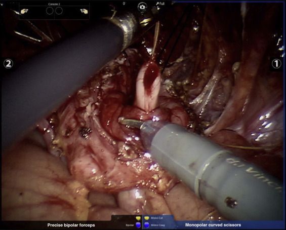 European Urology (@euplatinum) on Twitter photo New Surgery in Motion from Logan Galansky <a href="/AndolfiCiro/">Ciro Andolfi</a> <a href="/badamic14/">Brittany Adamic</a> Mohan S. Gundeti
Continent Cutaneous Catheterizable Channels in Pediatric Patients: A Decade of Experience with Open and Robotic Approaches in a Single Center buff.ly/31JQJU5 New Surgery in Motion from Logan Galansky <a href="/AndolfiCiro/">Ciro Andolfi</a> <a href="/badamic14/">Brittany Adamic</a> Mohan S. Gundeti
Continent Cutaneous Catheterizable Channels in Pediatric Patients: A Decade of Experience with Open and Robotic Approaches in a Single Center buff.ly/31JQJU5