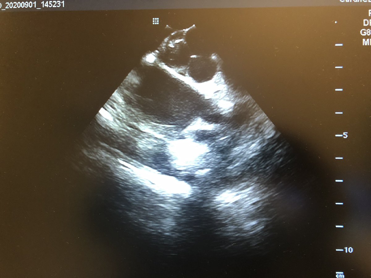 Great case today! 25 yo with frequent symptomatic Peri-hisian atrial tachycardia.  ICE, HDGrid, and tacticath made for a very enjoyable, successful case. Was able to get it on NCC. Did with 0 fluoro as well.  #EPeeps