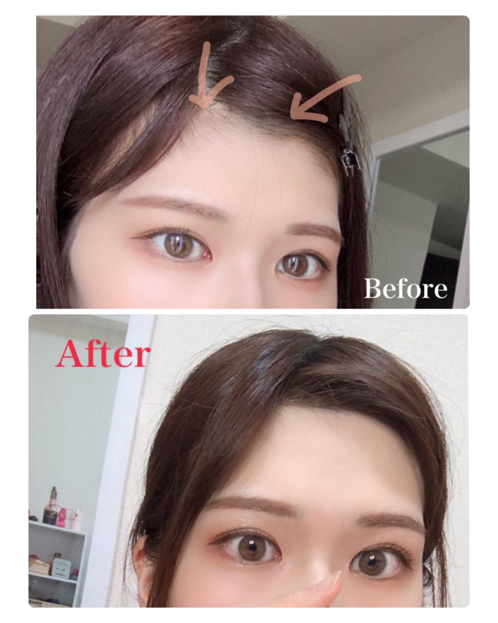 Yumika 長年おでこ狭いのが気になってて生え際の脱毛をしたんですが おでこが丸く綺麗に見えるし顔スッキリするのでやって良かった 月1で通って無くしていく予定 経過が楽しみ 長くなるので詳細はインスタに書きました T Co Zjwde3ikmx Yumika 長年おでこ狭いのが気になってて生え際の脱毛をしたんですが おでこが丸く綺麗に見えるし顔スッキリするのでやって良かった 月1で通って無くしていく予定 経過が楽しみ 長くなるので詳細はインスタに書きました T Co Zjwde3ikmx
