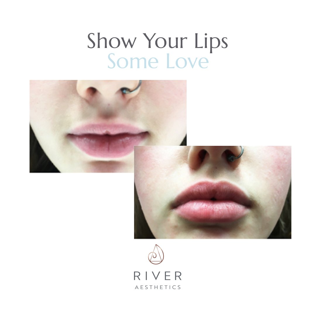 This September, every Lip Filler patient will have a complimentary Lip Perk treatment at their review appointment.

👄 Loosen dirt, oil &amp; dead skin cells 
👄 Gently cleanse and hydrate 
👄 Deliver antioxidants and nutrients &amp; more! 

Book today: 01202 024060.