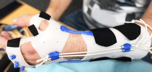 Orfit's tweet photo. FESSH-EFSHT 2020 Attendees, listen up! You can now learn how to make this Low Profile Radial Nerve Palsy Orthosis.
👉 Watch Debby Schwartz’s E-poster presentation at EFSHT Online! to find out more.
#EFSHT2020 #FESSH2020 #HandTherapy #Orfit https://t.co/0sEGrxNJmb