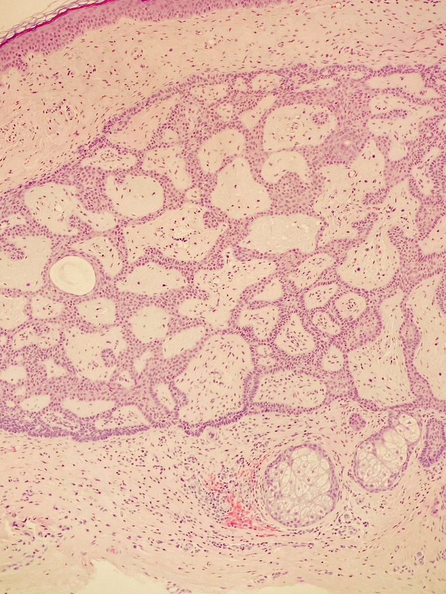 martinwpath's tweet photo. Firbroepithelioma of Pinkus: premalignant lesion composed of interconnected and branching strands of basaloid cells embedded in a loose fibrovascular stroma. Extends from epidermis to dermis. https://t.co/Fpoho6XEzc