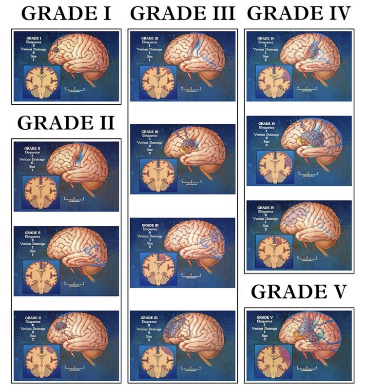 HYHUTriangle's tweet photo. In Oct. 1986, Drs. Robert Spetzler and Neil Martin published a paper in @TheJNS proposing a grading system to predict the risks of surgery in individual cases of AVMs. The #SpetzlerMartin #BTSM grading scale is still widely used today. @BarrowNeuro: Wow! https://t.co/ZInX3hZj5h https://t.co/b559dKWgjC