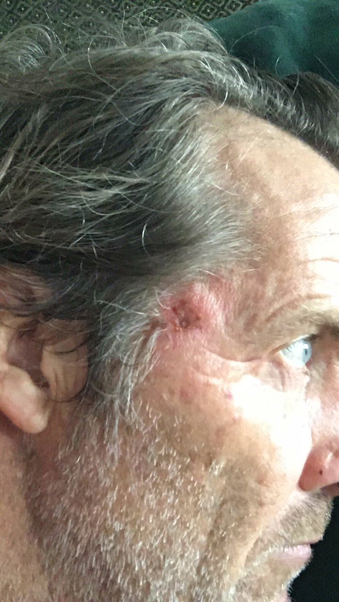 Make sure you check in with your demo couple of times a year. I’ve had to do some cream application before on my back this is my first on my face two more weeks to go