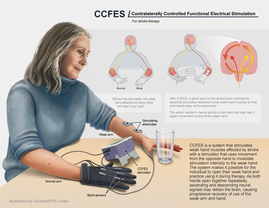 ClevelandFES's tweet image. #WednesdaySketch #artbyfes
CCFES is a system designed by Jayme Knutson, PhD that makes it possible for research participants affected by Stroke to open their weak hand and practice using it during therapy. 

bit.ly/2QLpdz9