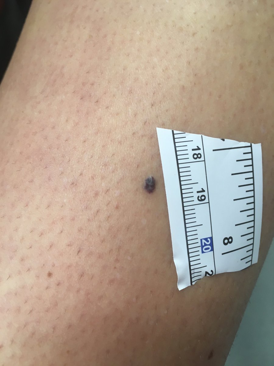 31 year old female shin