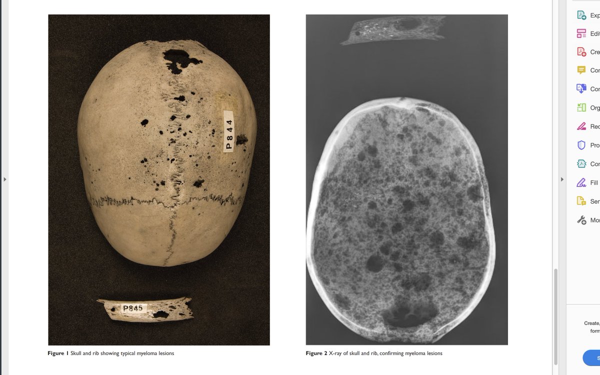 Spigelman and colleagues imaged the calvaria. Below right is a figure from their paper, as well as 1) two sketches of several representative bones drawn by one of Hunter's autopsy assistant, William Bell, and 2) upper right, another SurgiCat photo from RCS./17